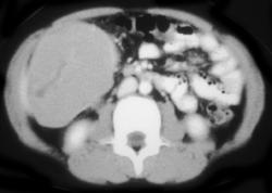 Burkitt Lymphoma of the Colon - CTisus CT Scan