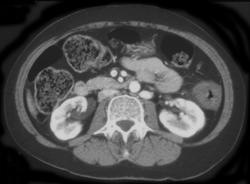 Ischemic Descending Colon - CTisus CT Scan