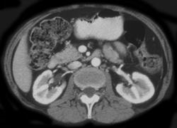 Ischemic Splenic Flexure - CTisus CT Scan