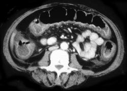 Pseudomembranous Colitis - CTisus CT Scan