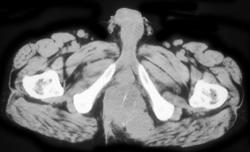 Rectal Cancer With Extension - CTisus CT Scan