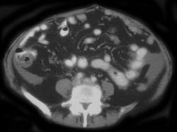 Carcinomatosis - CTisus CT Scan