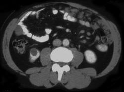 Carcinomatosis Secondary to Colon Cancer - CTisus CT Scan