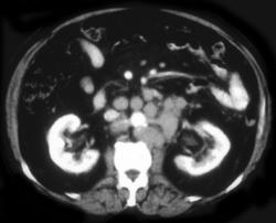 Adenopathy Due to Rectal Cancer - CTisus CT Scan