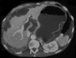 Pseudomyxoma Peritonei (PMP) - CTisus CT Scan