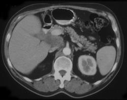 Portacaval Nodes Secondary to Recurrent Right Colon Cancer - CTisus CT Scan