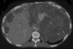 Pseudomyxoma Peritonei (PMP) - CTisus CT Scan