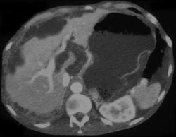 Pseudomyxoma Peritonei (PMP) - CTisus CT Scan