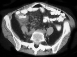 Recurrent Right Colon Cancer - CTisus CT Scan