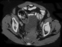 Recurrent Rectal Cancer - CTisus CT Scan