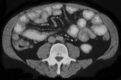 Radiation Charges of the Small Bowel in Patient W/post-op Radiation Therapy - CTisus CT Scan