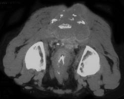 Recurrent Rectal Cancer Simulates A Chordoma - CTisus CT Scan