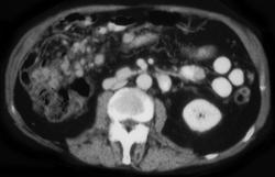 Carcinomatosis - CTisus CT Scan