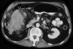 Carcinomatosis - CTisus CT Scan