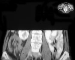 Cecal Carcinoma W/intussusception - CTisus CT Scan