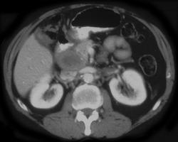 Portocaval Nodes- Cancer of Colon - CTisus CT Scan