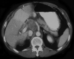 Portocaval Nodes - CTisus CT Scan