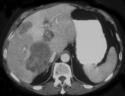 Liver Metastases and Portocaval Nodes - CTisus CT Scan