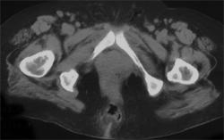 Perirectal Abscess - CTisus CT Scan