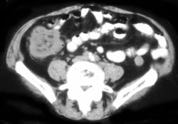 Cecal Carcinoma - CTisus CT Scan