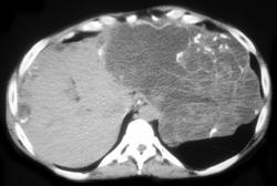 Pseudomyxoma Peritonei (PMP) - CTisus CT Scan