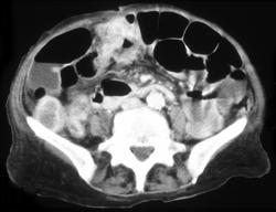 Colon Cancer - CTisus CT Scan