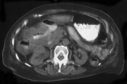 Colon Cancer Invades the Duodenum - CTisus CT Scan