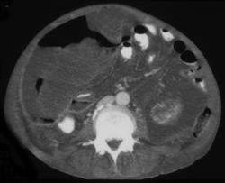 Pseudomyxoma Peritonei (PMP) - CTisus CT Scan