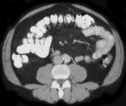 Mesenteric Panniculitis - CTisus CT Scan