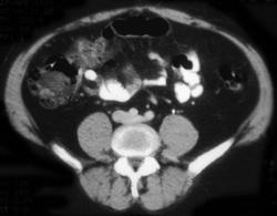 Inflamed Appendix Epiploicae - CTisus CT Scan