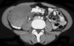 Melanoma Metastatic to Colon - CTisus CT Scan