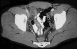 Appendicitis - CTisus CT Scan