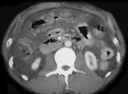 Pseudomembranous Colitis (PMC) - CTisus CT Scan