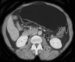 Cecal Volvulus - CTisus CT Scan