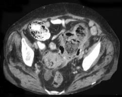 Perforated Sigmoid Colon W/abscess - CTisus CT Scan