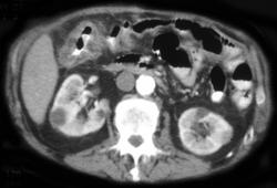 Ischemic Colitis - CTisus CT Scan