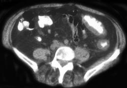 Ischemic Colitis - CTisus CT Scan