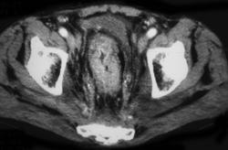 Pseudomembranous Colitis (PMC) - CTisus CT Scan