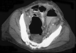 Pelvic Abscess S/P Colon Resection - CTisus CT Scan