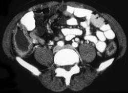 Ulcerative Colitis - CTisus CT Scan