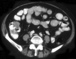 Cecal Cancer - CTisus CT Scan