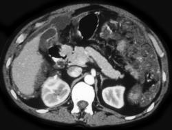 Carcinomatosis - CTisus CT Scan