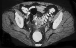 Diverticulitis W/fistulae to Cervix - CTisus CT Scan