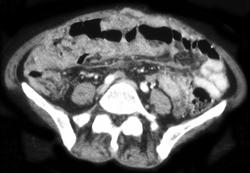 Carcinomatosis - CTisus CT Scan