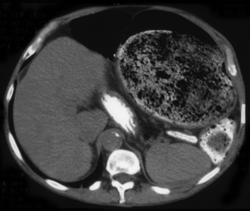 Hirschsprungs - CTisus CT Scan