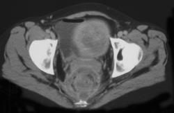 Ulcerative Colitis W/perirectal Fistulae - CTisus CT Scan