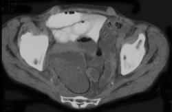 Ischemic Bowel - CTisus CT Scan