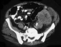 Colon Cancer - CTisus CT Scan