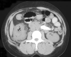 Pseudomembranous Colitis (PMC) - CTisus CT Scan