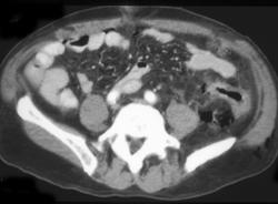 Perforated Colon With Free Air S/P... - CTisus CT Scan